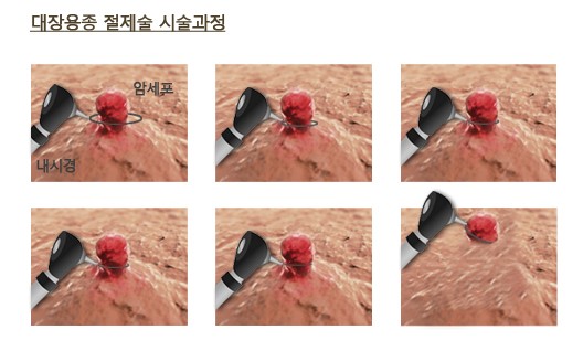 대장 용종 절제술 시술 과정